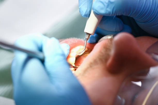 Best Emergency Root Canal Treatment in Keller, TX